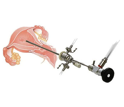 Hysteroscopic adhesiolysis for uterine adhesions