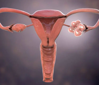 PCOS treatment and management