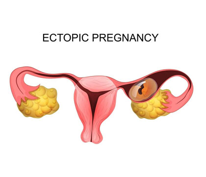 Endometriosis diagnosis and surgery